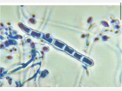 Severe Drug-Resistant Skin Infection Never Before Seen In US Detected In NY